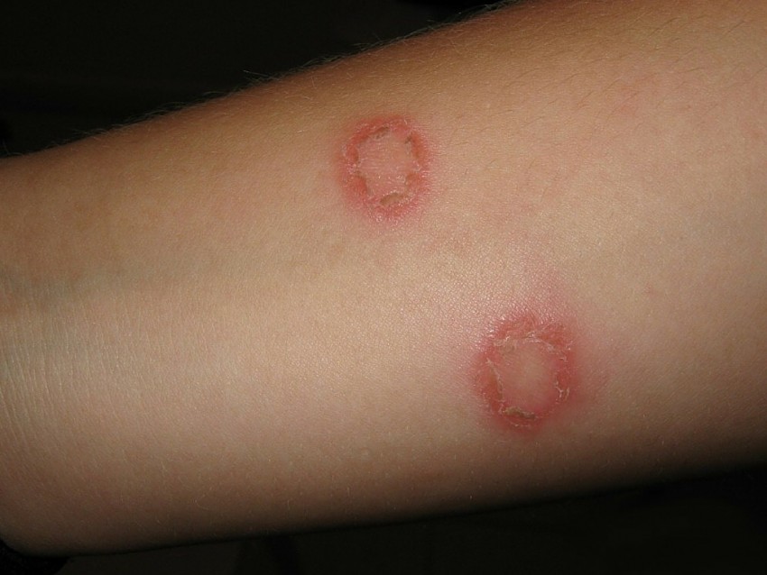 Плоский лишай - первые симптомы, причины появления, сведения о болезни и эффективное лечение (100 фото)