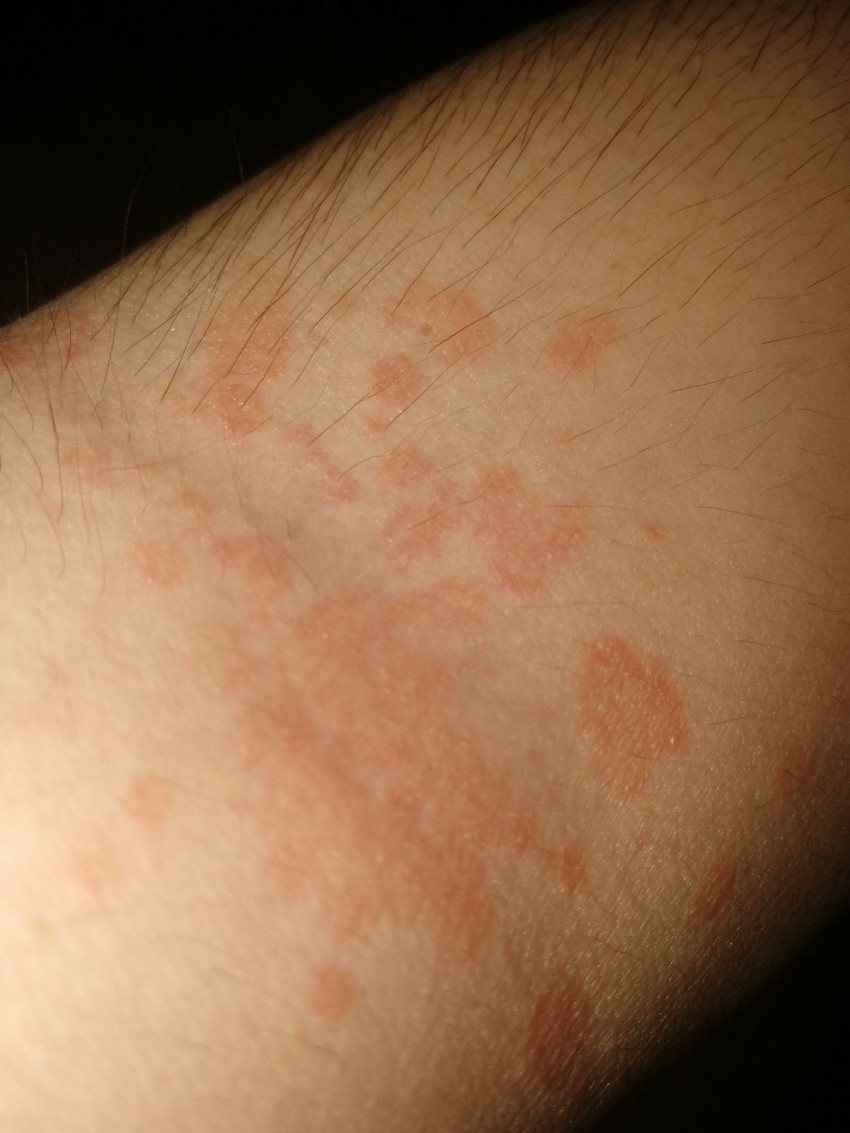 Плоский лишай - первые симптомы, причины появления, сведения о болезни и эффективное лечение (100 фото)