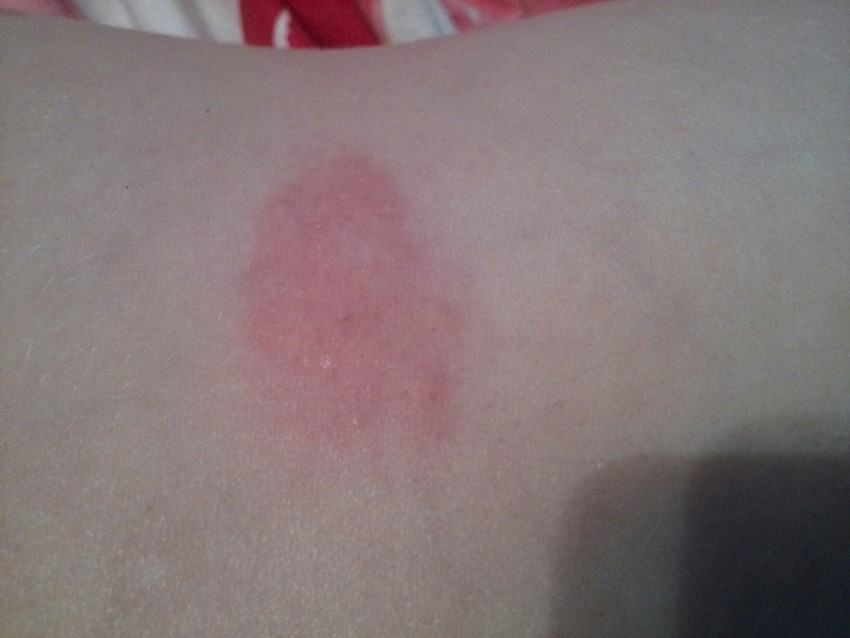 Плоский лишай - первые симптомы, причины появления, сведения о болезни и эффективное лечение (100 фото)