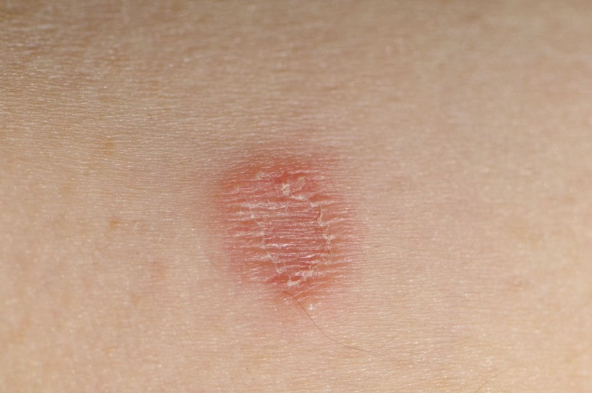 Плоский лишай - первые симптомы, причины появления, сведения о болезни и эффективное лечение (100 фото)