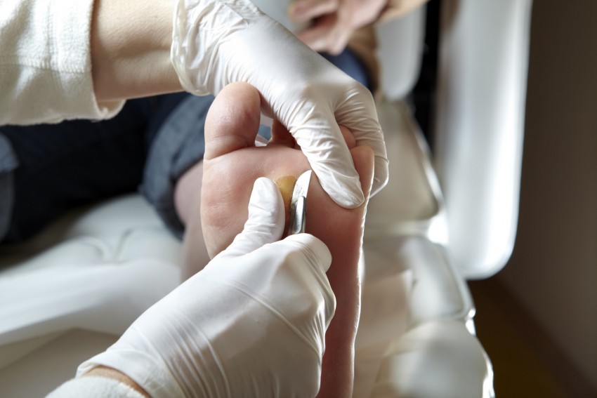 Подошвенная бородавка: причины появления, первые симптомы и варианты удаления (100 фото и видео)