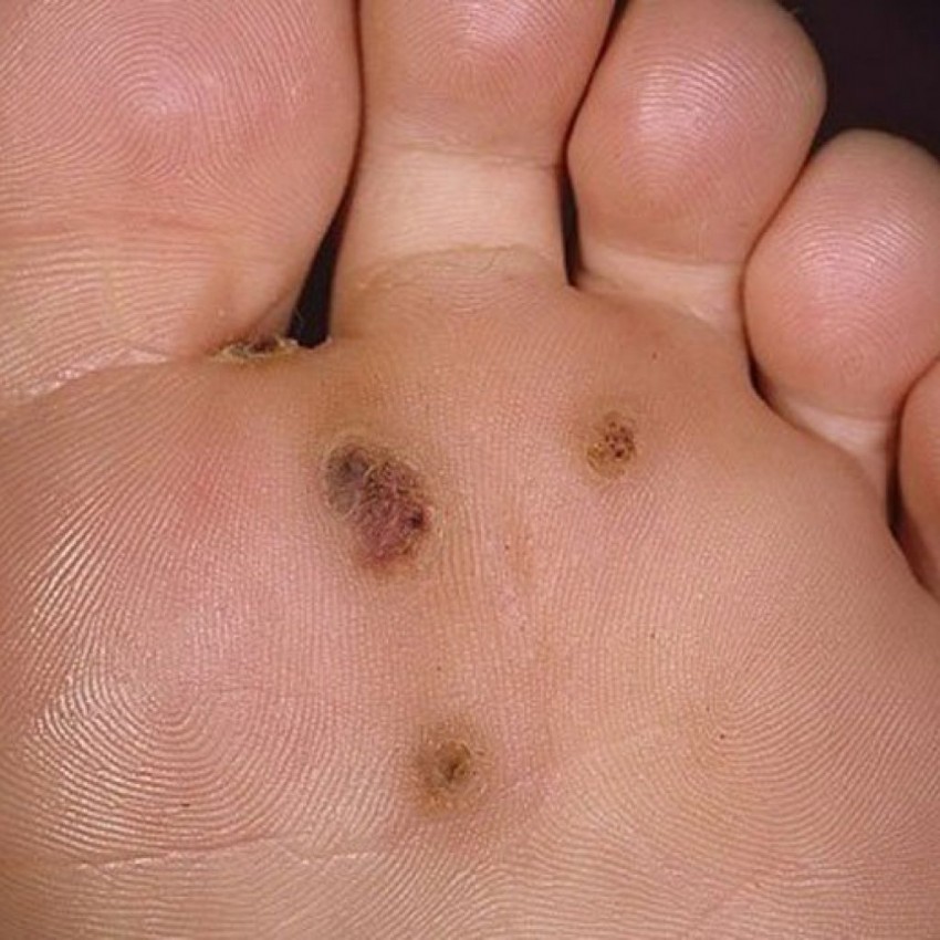 Подошвенная бородавка: причины появления, первые симптомы и варианты удаления (100 фото и видео)