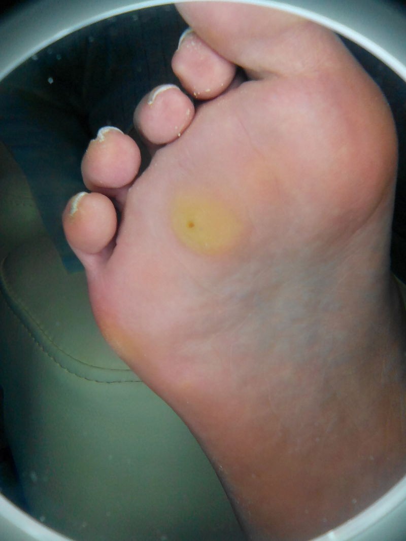 Подошвенная бородавка: причины появления, первые симптомы и варианты удаления (100 фото и видео)