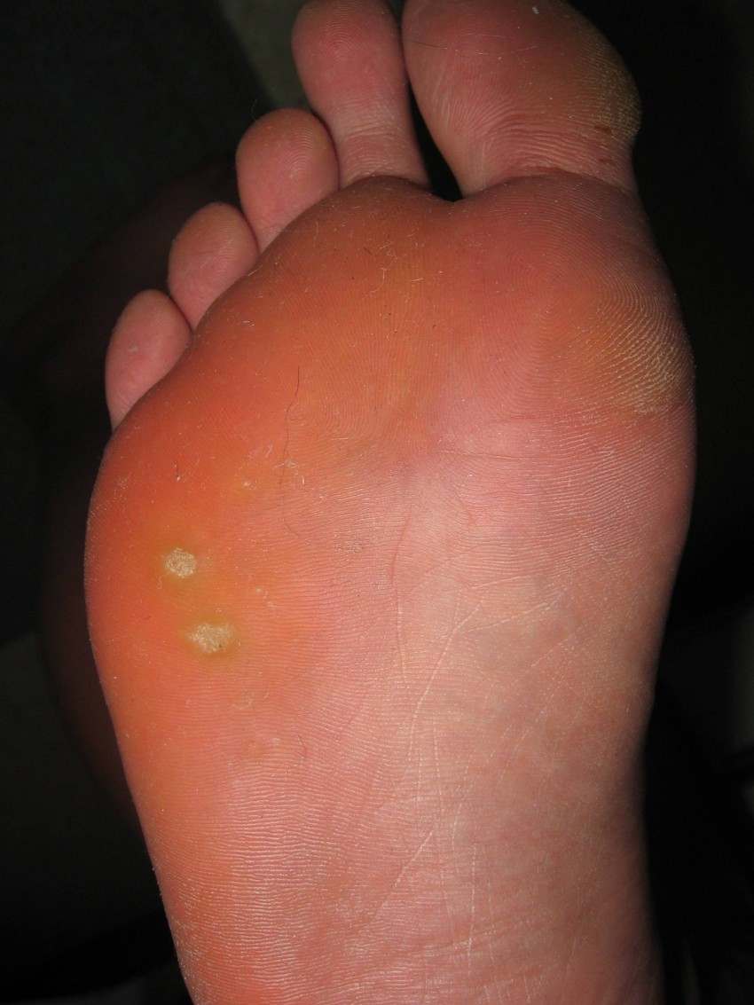 Подошвенная бородавка: причины появления, первые симптомы и варианты удаления (100 фото и видео)