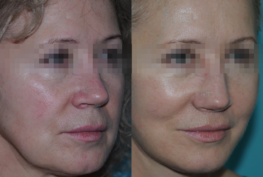 Подтяжка лица: плюсы, минусы, пошаговое описание процедуры и современные виды подтяжек (115 фото)