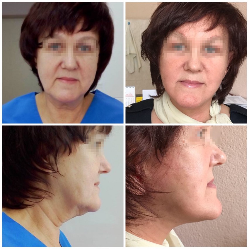 Подтяжка лица: плюсы, минусы, пошаговое описание процедуры и современные виды подтяжек (115 фото)