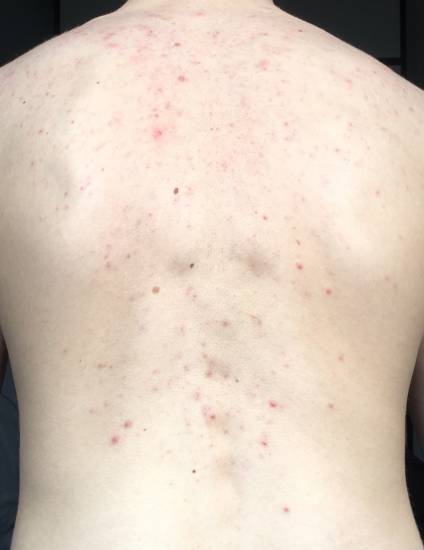 Причины появления прыщей: симптомы болезней, диагностика, лечение и советы как избавиться от прыщей (75 фото)