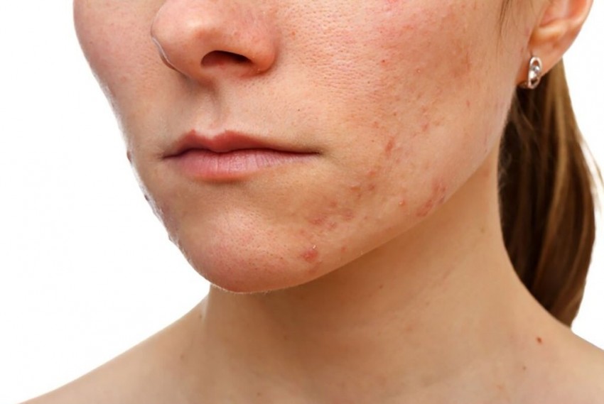 Причины появления прыщей: симптомы болезней, диагностика, лечение и советы как избавиться от прыщей (75 фото)