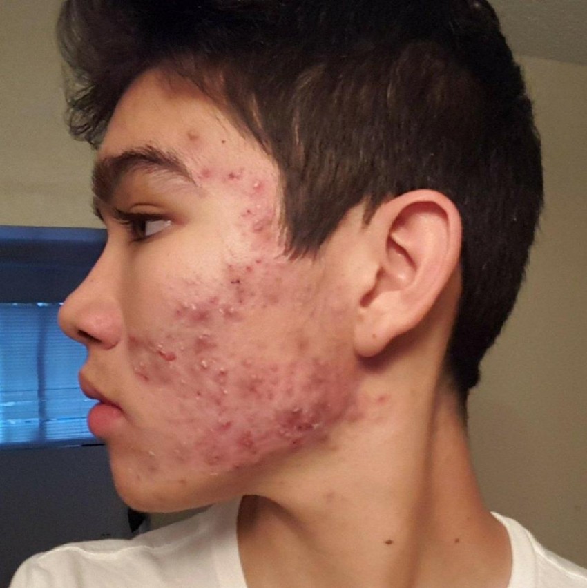 Причины появления прыщей: симптомы болезней, диагностика, лечение и советы как избавиться от прыщей (75 фото)