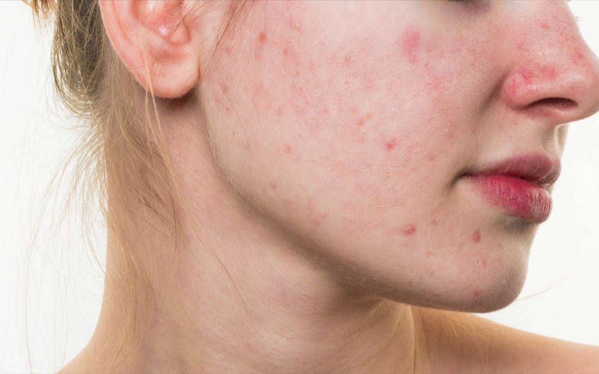 Причины появления прыщей: симптомы болезней, диагностика, лечение и советы как избавиться от прыщей (75 фото)