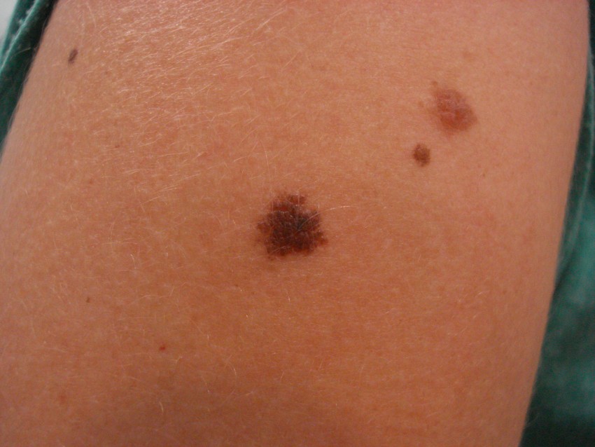 Причины появления родинок: как возникают и когда становятся опасными родинки на теле (110 фото и видео)