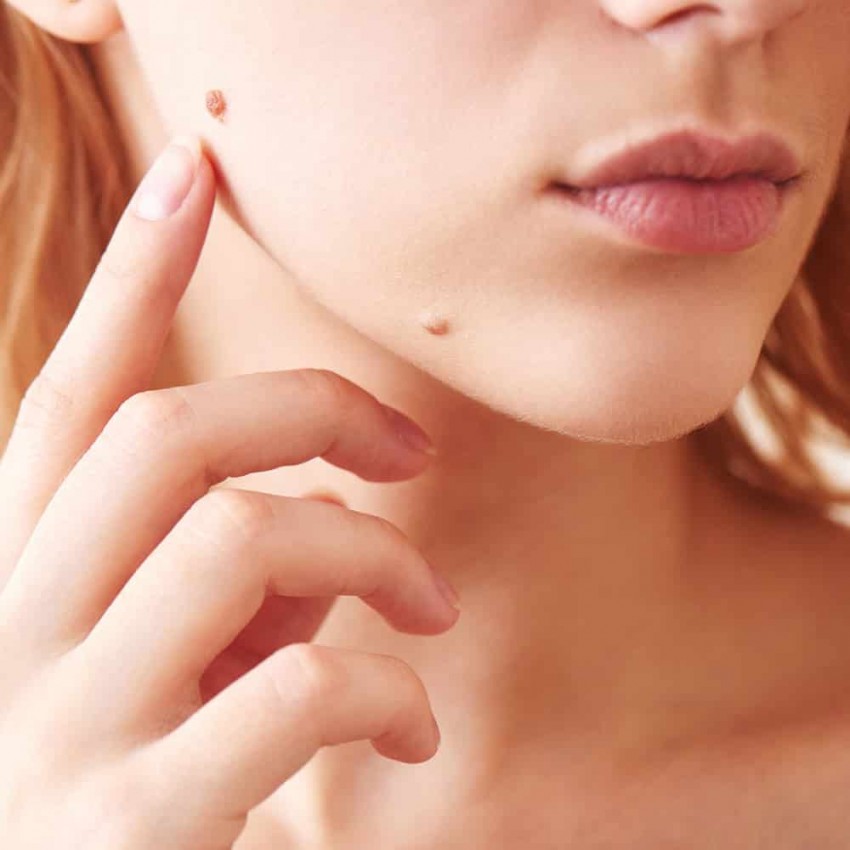 Причины появления родинок: как возникают и когда становятся опасными родинки на теле (110 фото и видео)