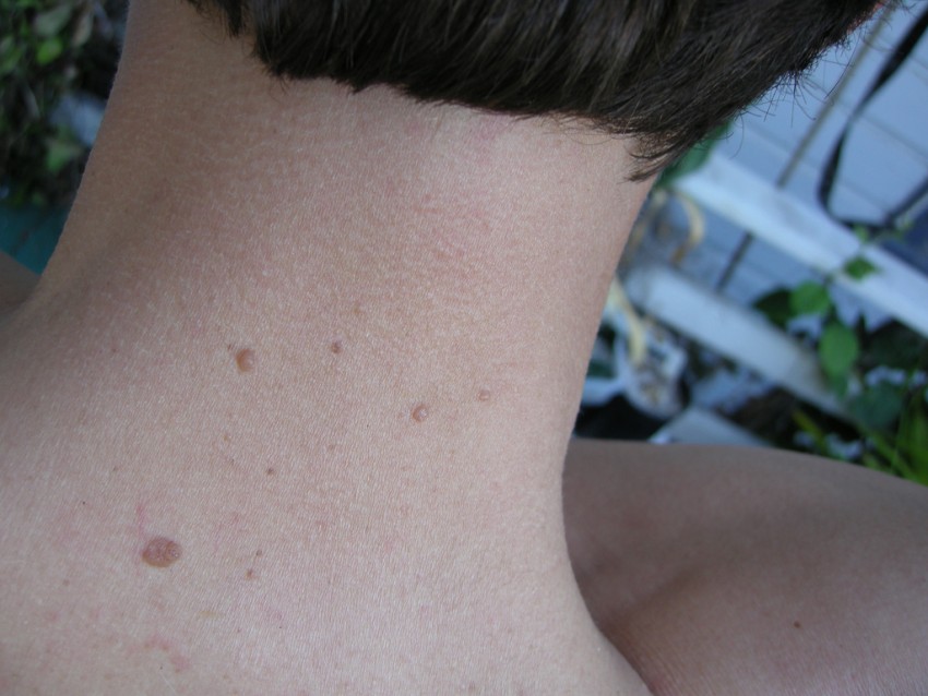 Причины появления родинок: как возникают и когда становятся опасными родинки на теле (110 фото и видео)