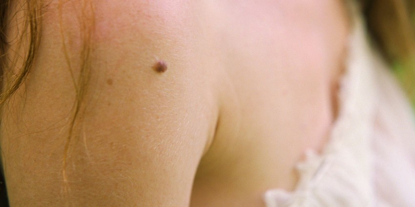 Причины появления родинок: как возникают и когда становятся опасными родинки на теле (110 фото и видео)