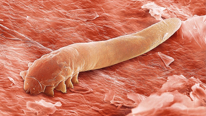 Причины прыщей: обзор основных причин и советы врачей как избавиться от прыщей. Профилактика появления прыщей (110 фото и видео)