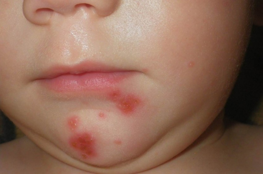Причины прыщей: обзор основных причин и советы врачей как избавиться от прыщей. Профилактика появления прыщей (110 фото и видео)