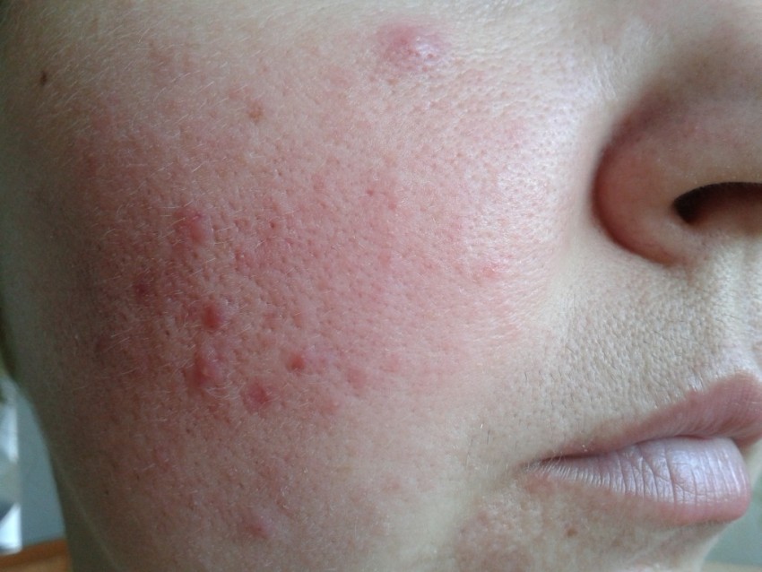 Причины прыщей: обзор основных причин и советы врачей как избавиться от прыщей. Профилактика появления прыщей (110 фото и видео)