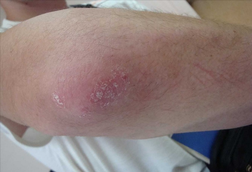 Причины возникновения псориаза: диагностика, причины проявления, симптомы, стадии и признаки развития болезни (120 фото)