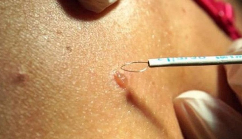 Прижигание бородавок: выведение бородавок народными способами в домашних условиях. Видео инструкция и 125 фото проведения процедуры