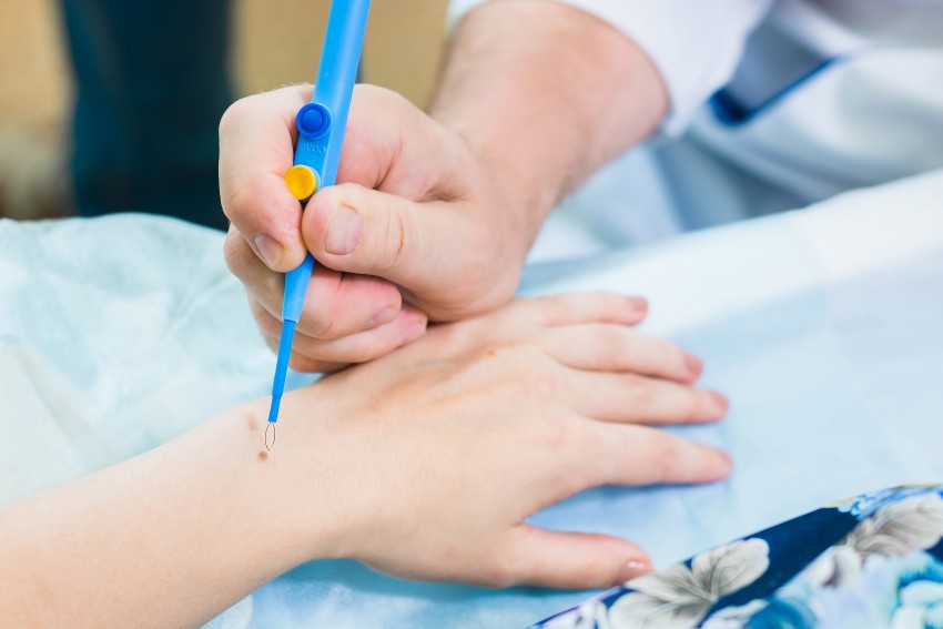 Прижигание бородавок: выведение бородавок народными способами в домашних условиях. Видео инструкция и 125 фото проведения процедуры