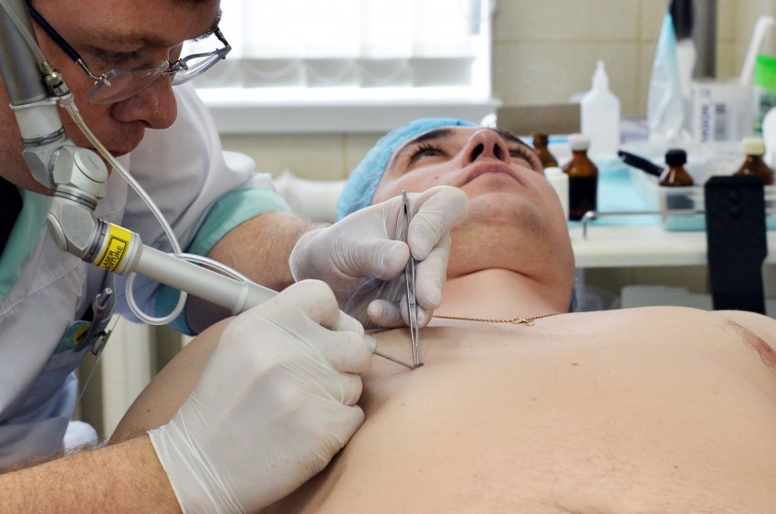 Прижигание бородавок: выведение бородавок народными способами в домашних условиях. Видео инструкция и 125 фото проведения процедуры