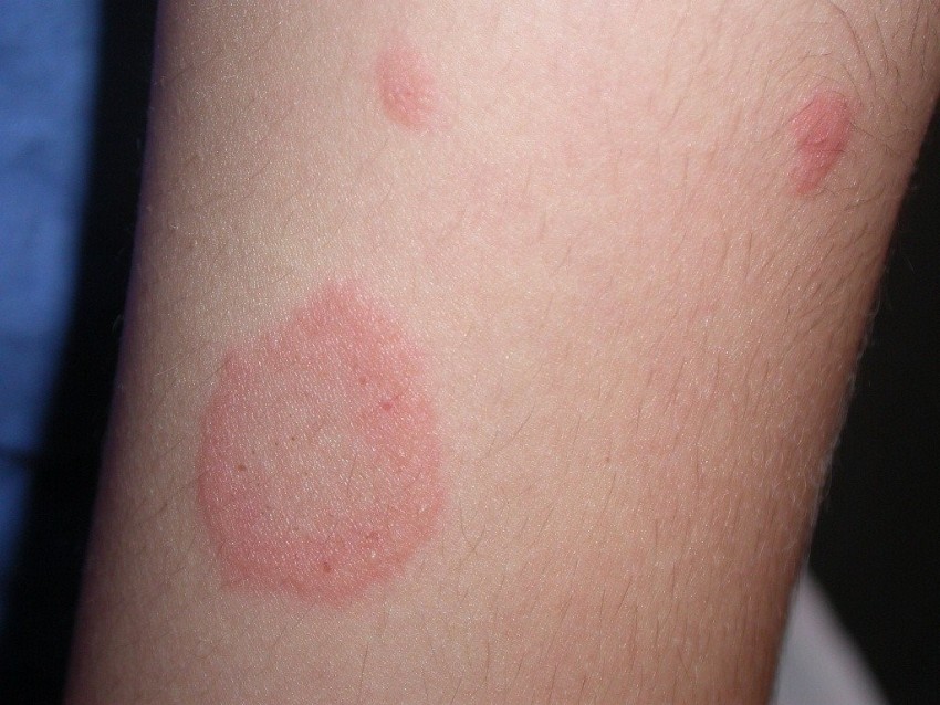 Признаки лишая - 130 фото и видео симптомов, диагностика причин и правила лечения у детей и взрослых