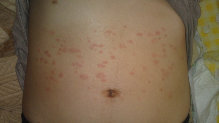 Признаки лишая - 130 фото и видео симптомов, диагностика причин и правила лечения у детей и взрослых