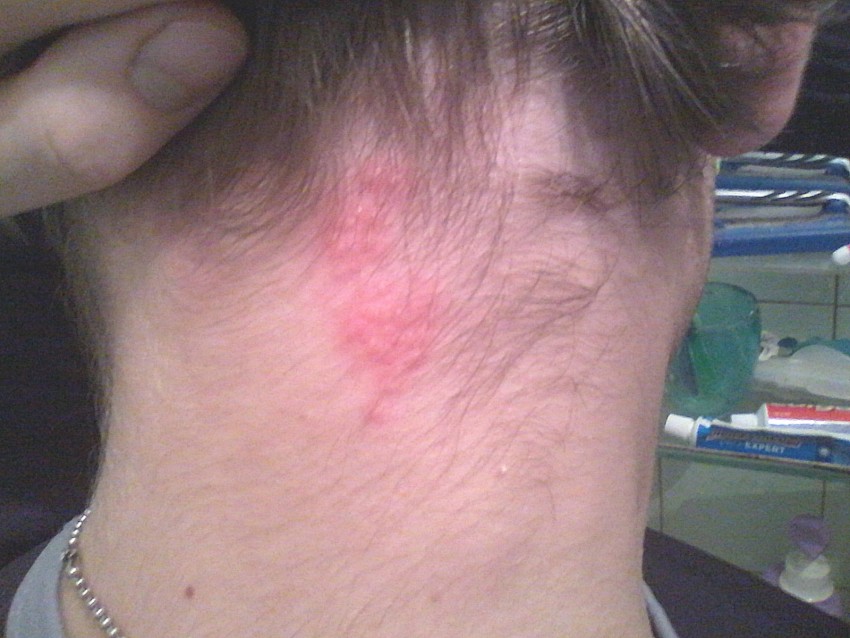 Признаки лишая - 130 фото и видео симптомов, диагностика причин и правила лечения у детей и взрослых