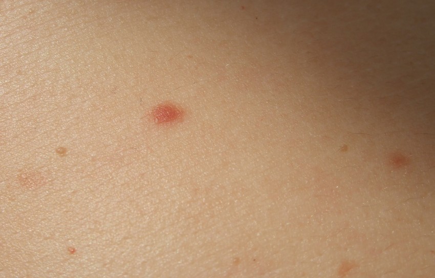 Проверить родинки - пошаговая инструкция как самостоятельно проверить родинки на онкологию. Советы экспертов и обзор типовых ситуаций (120 фото и видео)