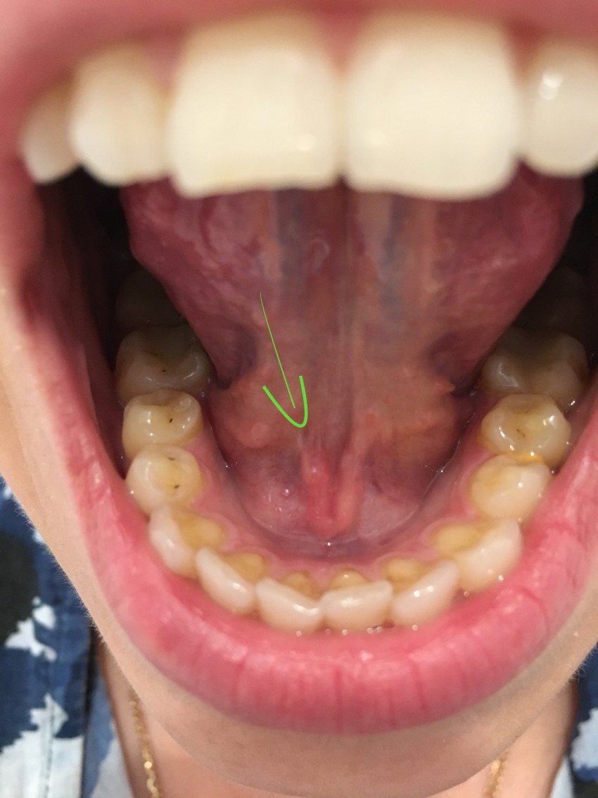 Прыщ на языке: 80 фото, описание, причины появления, лечение и советы по профилактике повторного появления