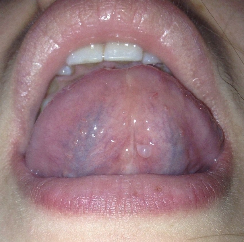 Прыщ на языке: 80 фото, описание, причины появления, лечение и советы по профилактике повторного появления