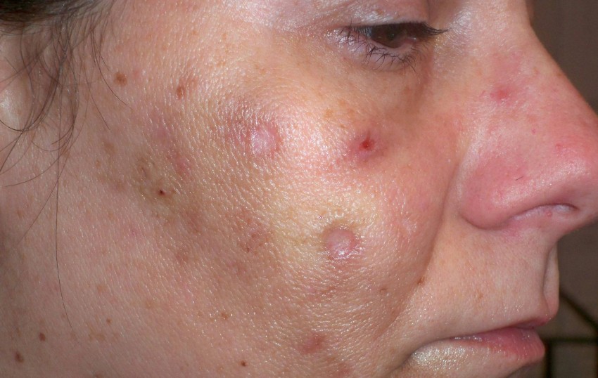 Прыщи на лице - советы дерматологов как избавиться быстро и эффективно от причины возникновения прыщей (120 фото)