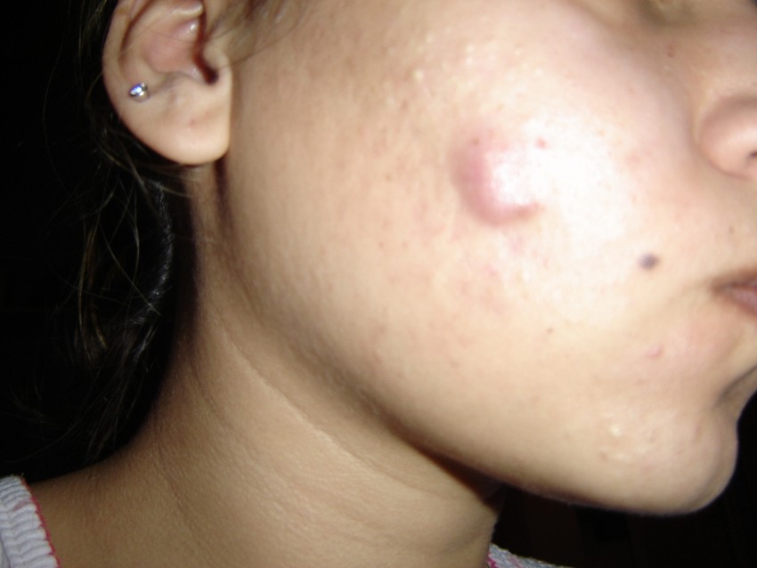 Прыщи на лице - советы дерматологов как избавиться быстро и эффективно от причины возникновения прыщей (120 фото)
