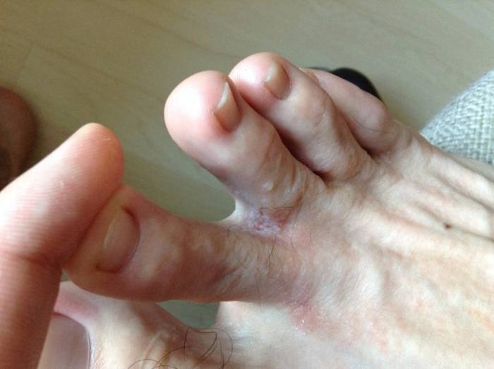 Прыщи на ногах: виды, причины появления, советы как избавиться от прыщей и угрей быстро и эффективно (120 фото и видео)