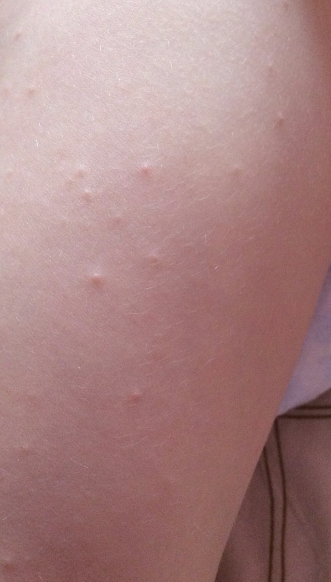 Прыщи на ногах: виды, причины появления, советы как избавиться от прыщей и угрей быстро и эффективно (120 фото и видео)