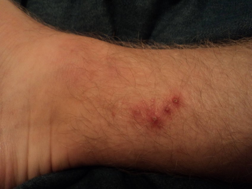 Прыщи на ногах: виды, причины появления, советы как избавиться от прыщей и угрей быстро и эффективно (120 фото и видео)