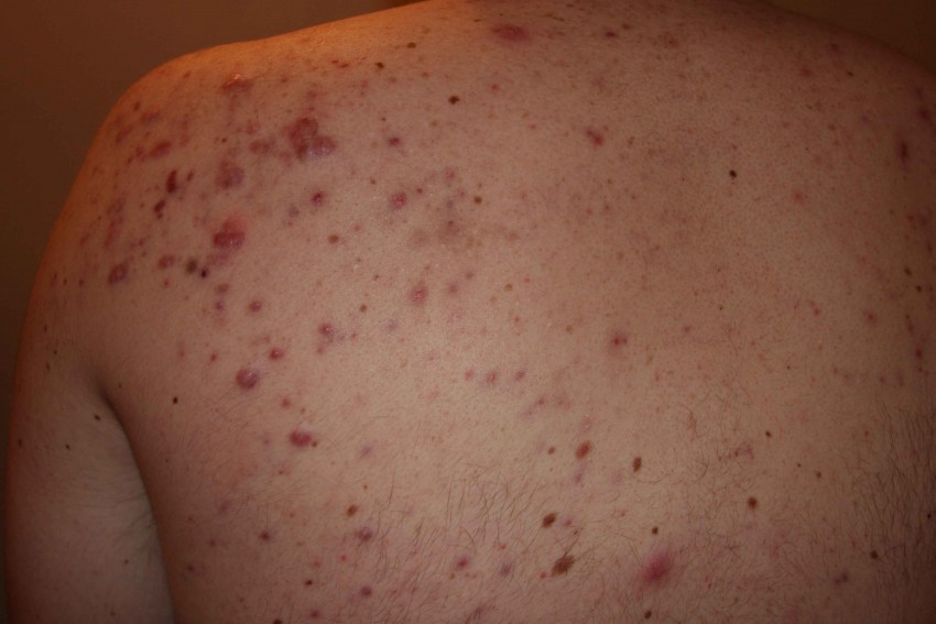 Прыщи на плечах - причины появления и методы удаления прыщей. Советы по выбору способа лечения (105 фото + видео)