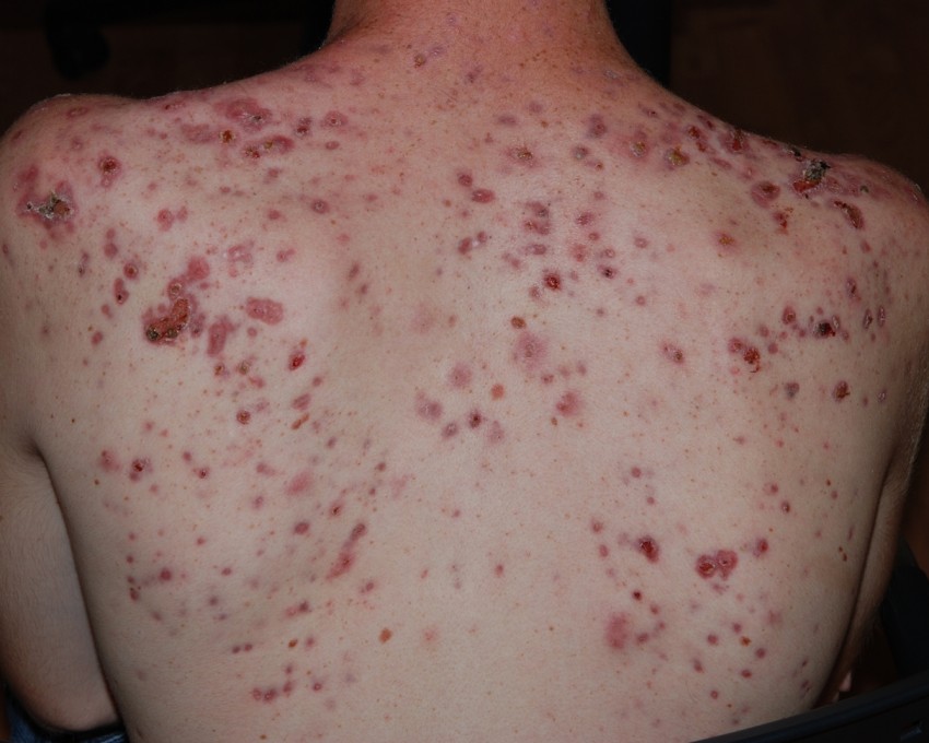 Прыщи на плечах - причины появления и методы удаления прыщей. Советы по выбору способа лечения (105 фото + видео)