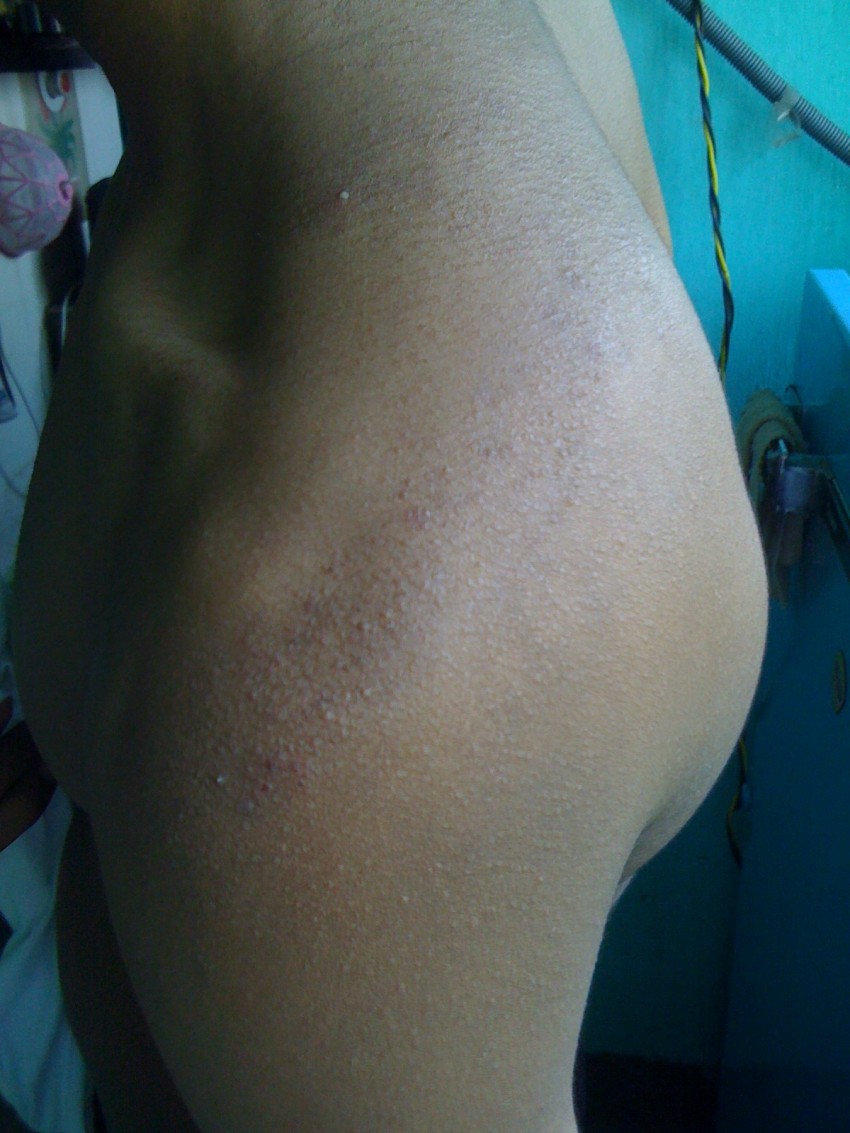 Прыщи на плечах - причины появления и методы удаления прыщей. Советы по выбору способа лечения (105 фото + видео)