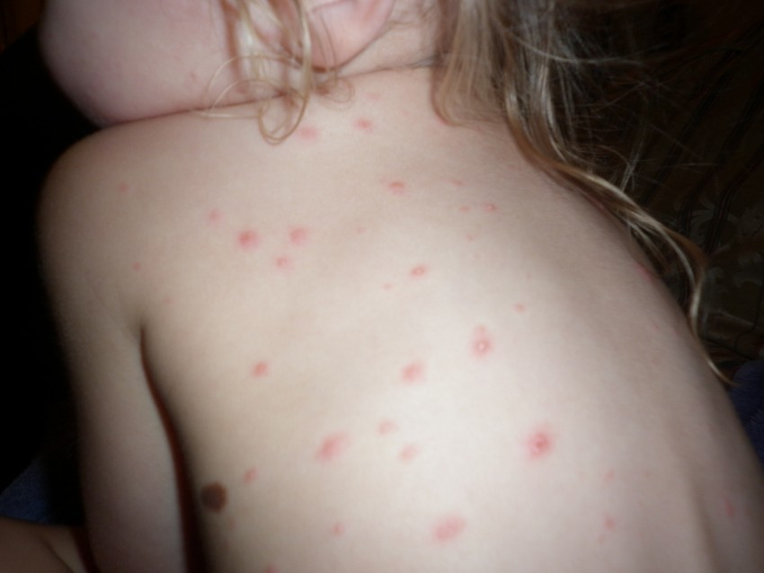 Прыщи на плечах - причины появления и методы удаления прыщей. Советы по выбору способа лечения (105 фото + видео)