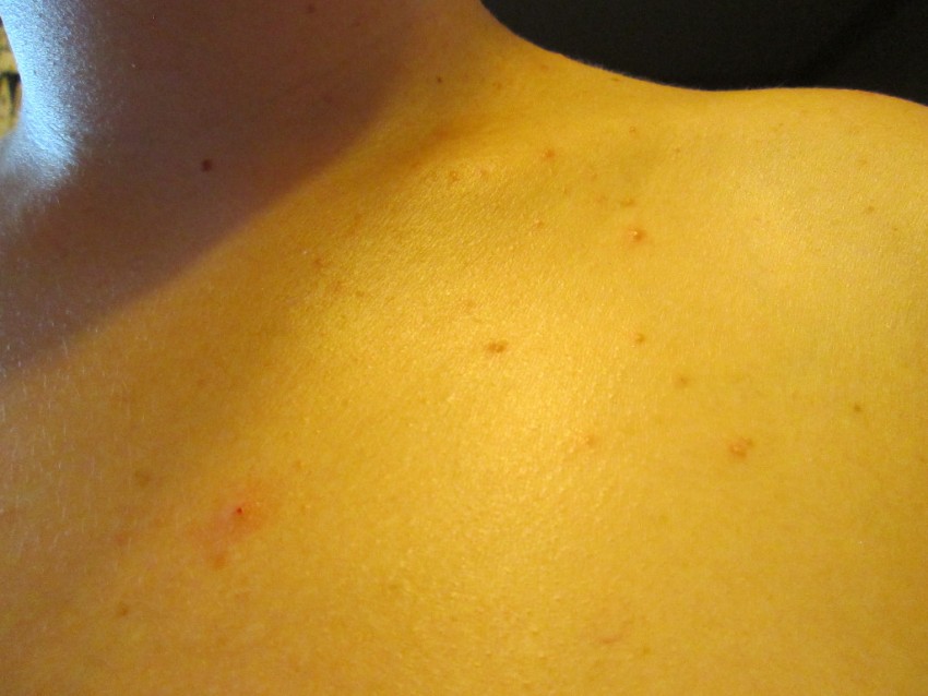 Прыщи на плечах - причины появления и методы удаления прыщей. Советы по выбору способа лечения (105 фото + видео)