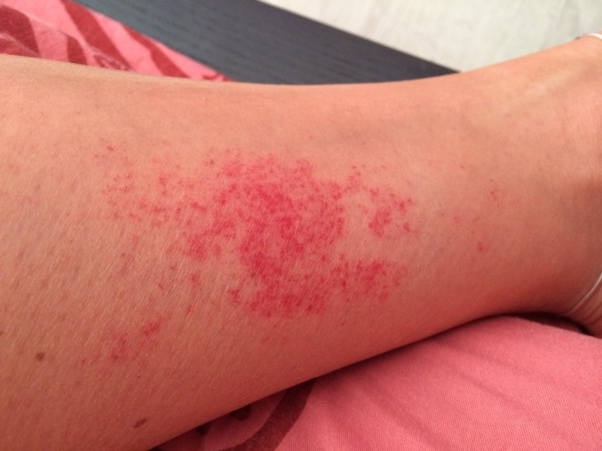 Прыщи на руках - причины появления, виды диагностика заболевания и избавления от прыщей. 115 фото самых распространенных проблем с кожей рук