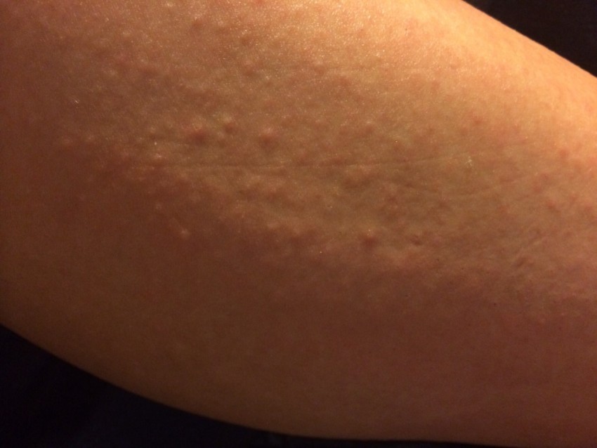 Прыщи на руках - причины появления, виды диагностика заболевания и избавления от прыщей. 115 фото самых распространенных проблем с кожей рук