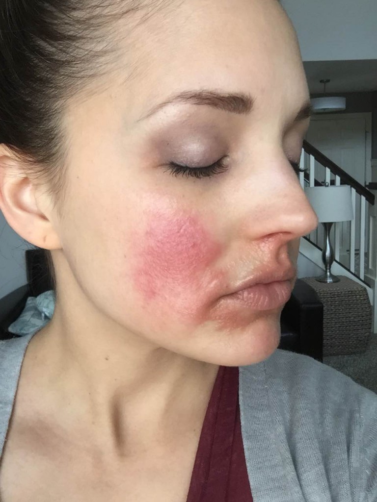 Прыщи на щеках: основные причины появления, советы как избавиться и вылечить кожу быстро и просто современными методами (видео и 110 фото)