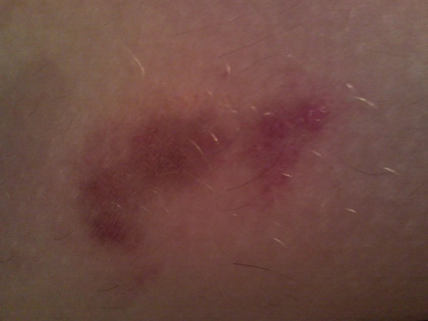 Прыщи на животе: причины появления, признаки заболевания и лучшие методы избавления в домашних условиях (115 фото)