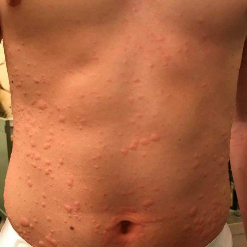 Прыщи на животе: причины появления, признаки заболевания и лучшие методы избавления в домашних условиях (115 фото)