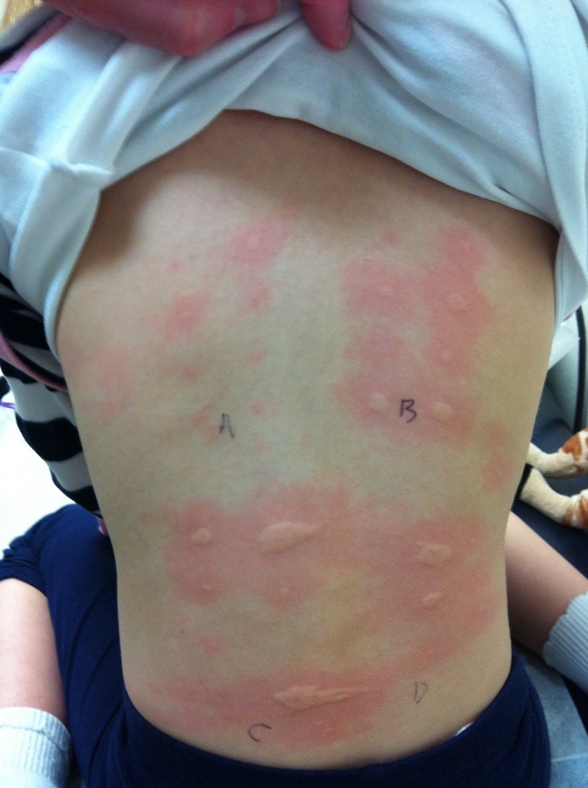 Прыщи на животе: причины появления, признаки заболевания и лучшие методы избавления в домашних условиях (115 фото)