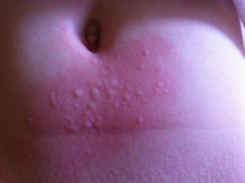 Прыщи на животе: причины появления, признаки заболевания и лучшие методы избавления в домашних условиях (115 фото)