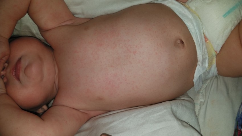 Прыщи на животе: причины появления, признаки заболевания и лучшие методы избавления в домашних условиях (115 фото)