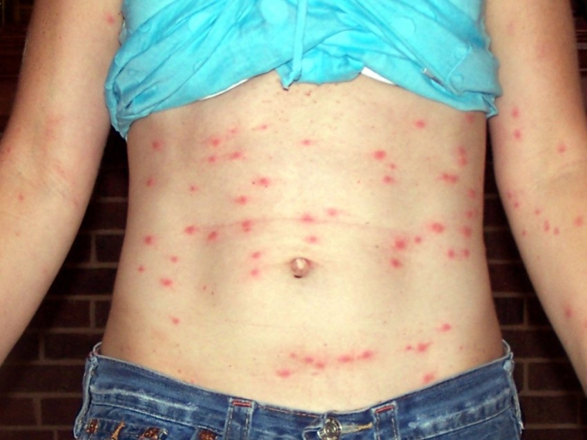 Прыщи на животе: причины появления, признаки заболевания и лучшие методы избавления в домашних условиях (115 фото)